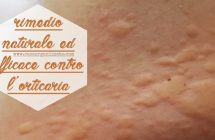 Rimedio naturale contro il prurito da orticaria